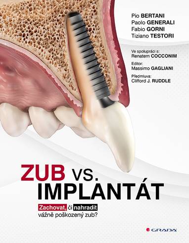 E-kniha Zub vs. implantát - Paolo Generali, Pio Bertani, Fabio Gorni, Tiziano Testori