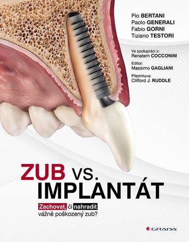 E-kniha Zub vs. implantát - kolektiv a, Pio Bertani, Paolo Generali, Fabio Gorni, Tiziano Testori